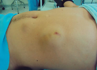 Todo tipo de hernias - imagen descriptiva